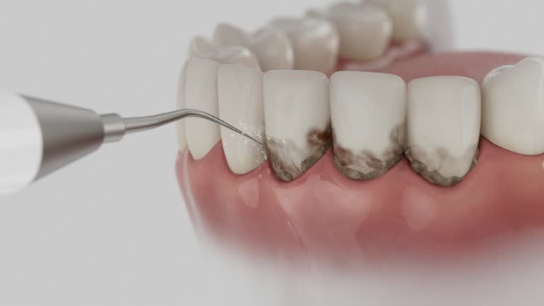 Reliable Dental Implants contractor in Fargo, ND by Smile Center Dentistry